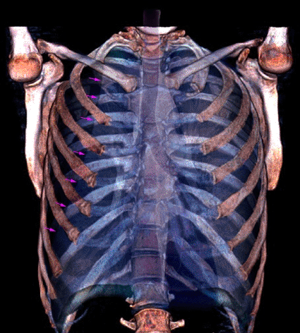 Imagen: Examen frontal de tomografía computarizada (TC) 3-D de los pulmones de un paciente con un neumotórax (Foto cortesía de Zephyr / SPL).